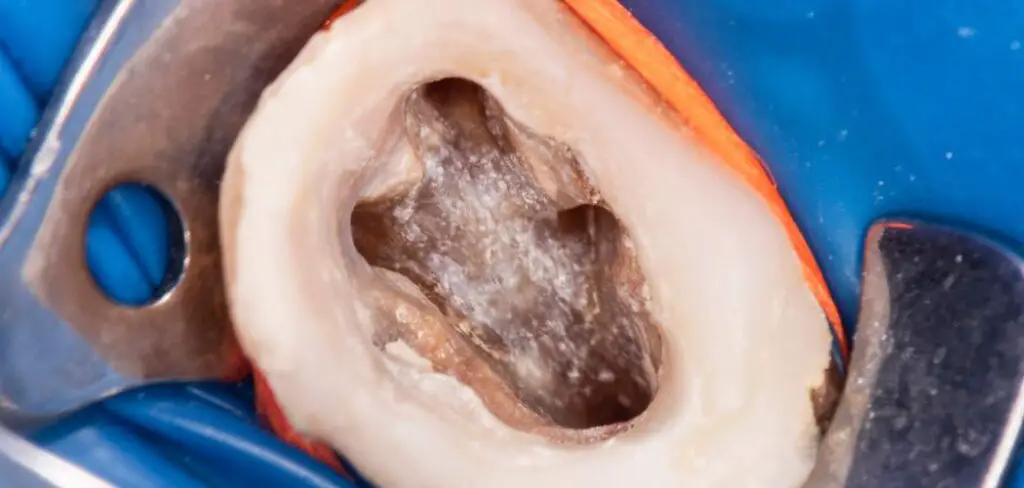 Can You Get Dry Socket After Root Canal?