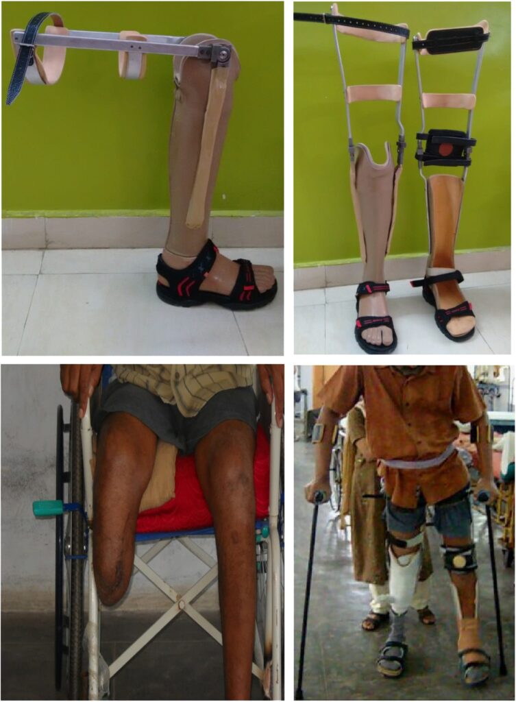 Prosthetic Solutions For Multiple Limb Amputations: Exploring Options ...